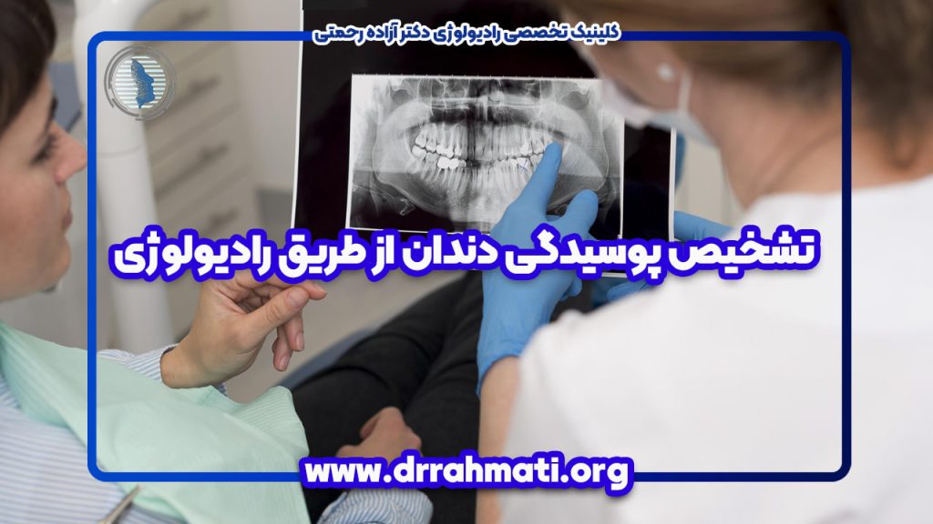تشخیص پوسیدگی دندان از طریق رادیولوژی -رادیولوژی لاهیجان