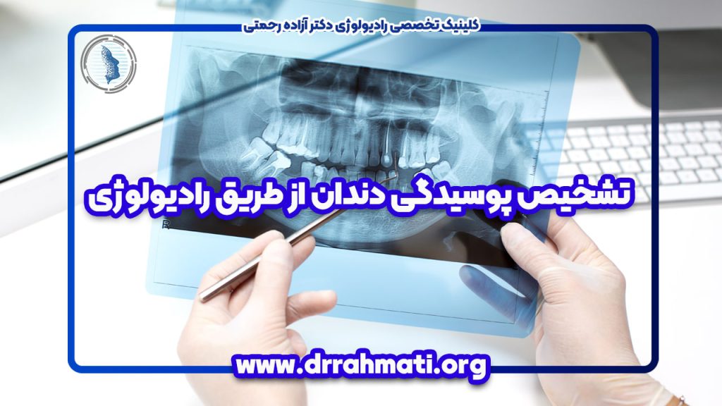 تشخیص پوسیدگی دندان از طریق رادیولوژی -دکتر آزاده رحمتی لاهیجان