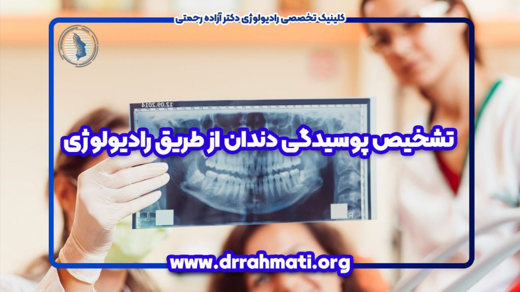 تشخیص پوسیدگی دندان از طریق رادیولوژی