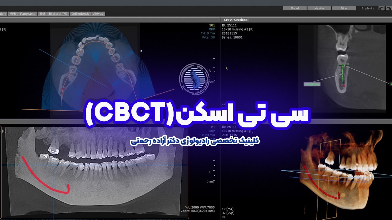 سی تی اسکن (CBCT) -سی تی اسکن با اشعه مخروطی در کلینیک دکتر آزاده رحمتی لاهیجان