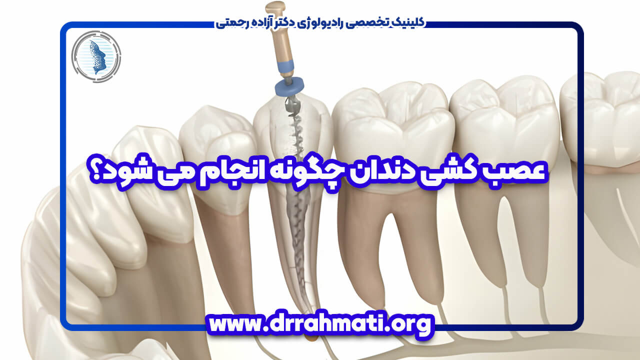 عصب کشی دندان چگونه انجام می شود