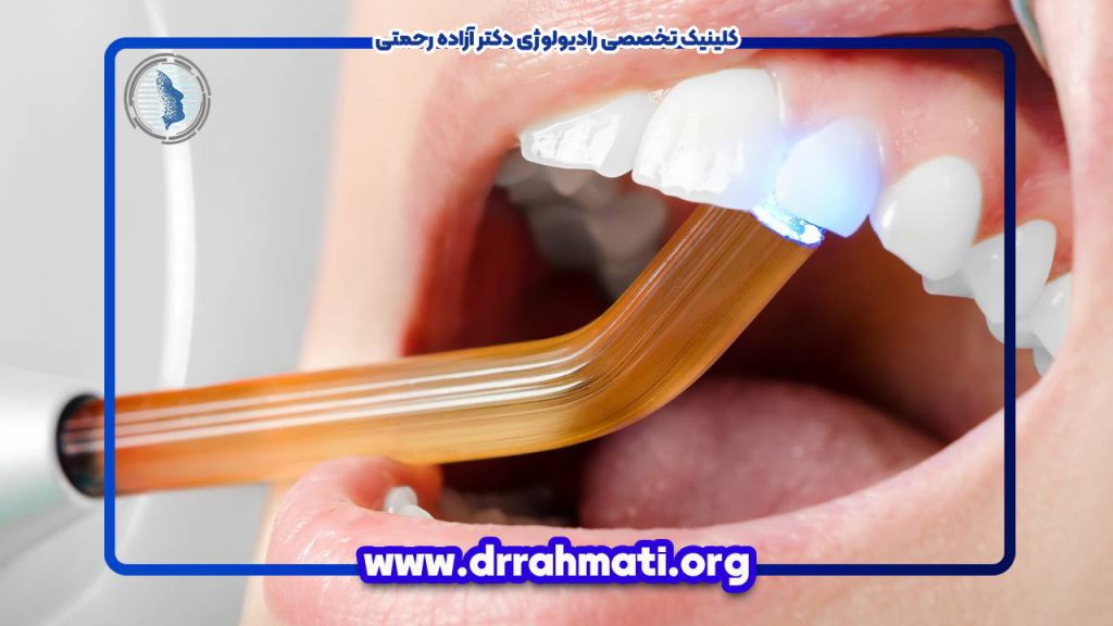 تخلیه عفونت دندان با عصب کشی