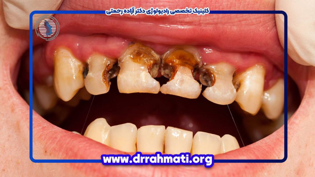 تعریف پوسیدگی دندان
