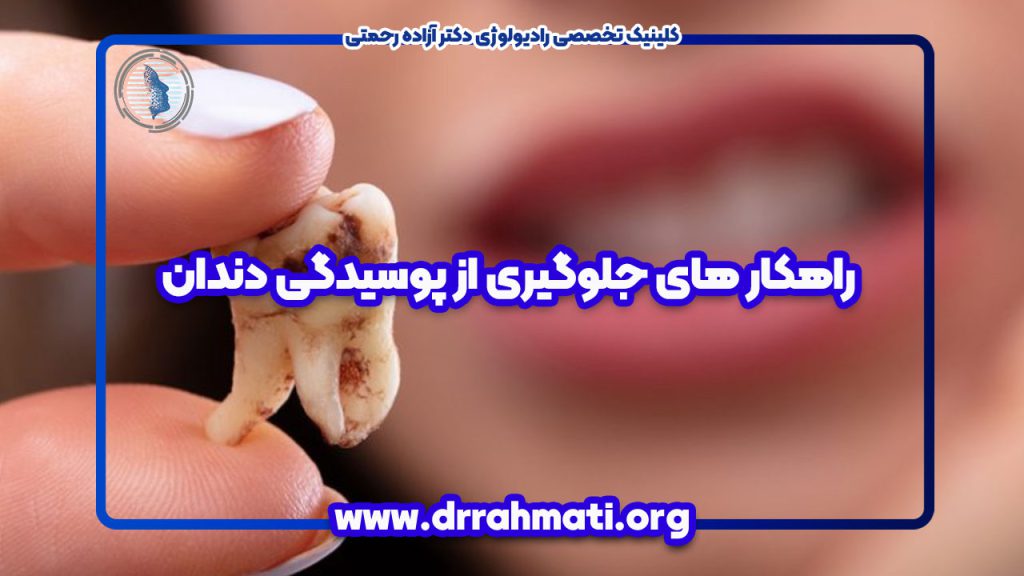 راهکار های جلوگیری از پوسیدگی دندان